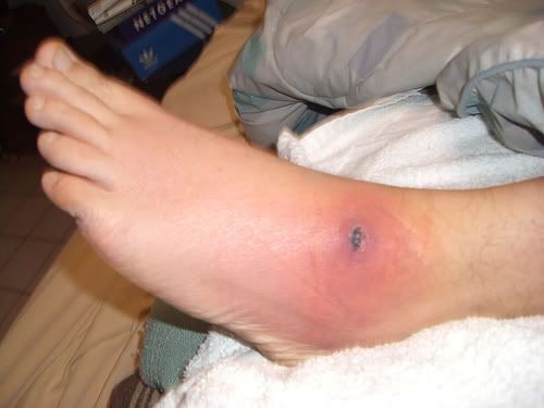 symptoms of merca staph infection